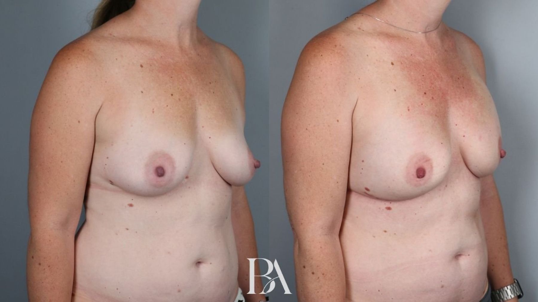 Direct-to-Implant Reconstruction before and after — oblique view, Dr. Beina Azadgoli, Beverly Hills