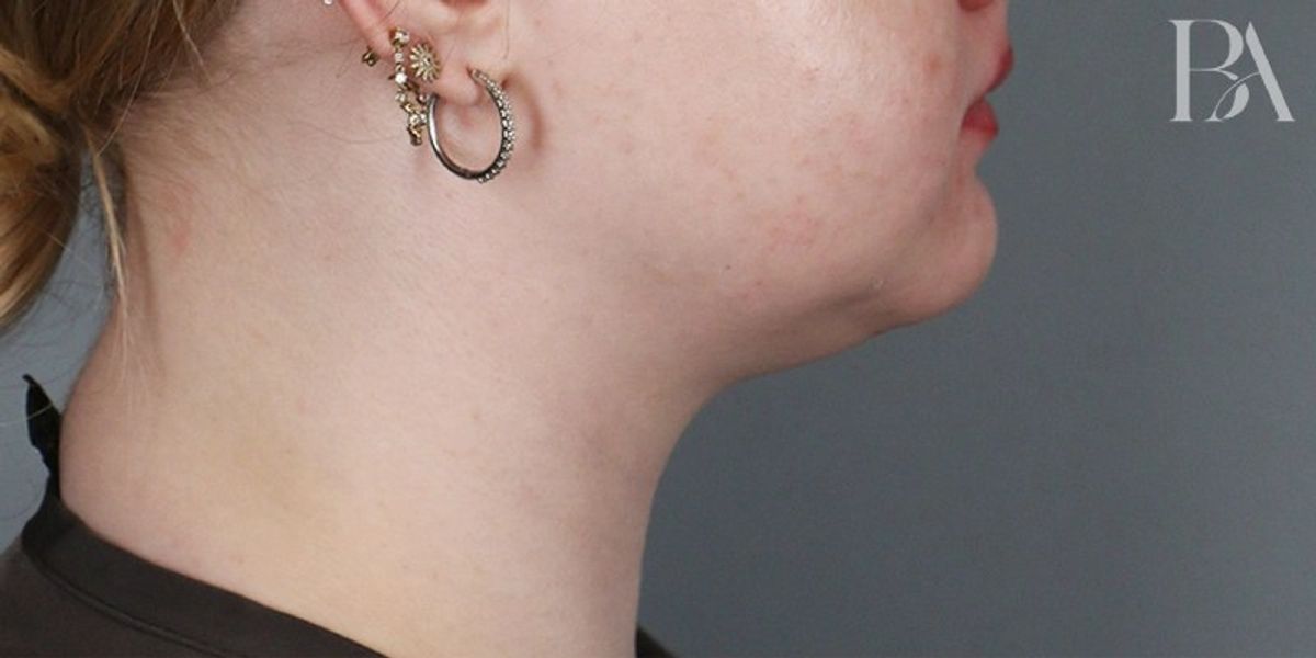 Case 4001 — Side before