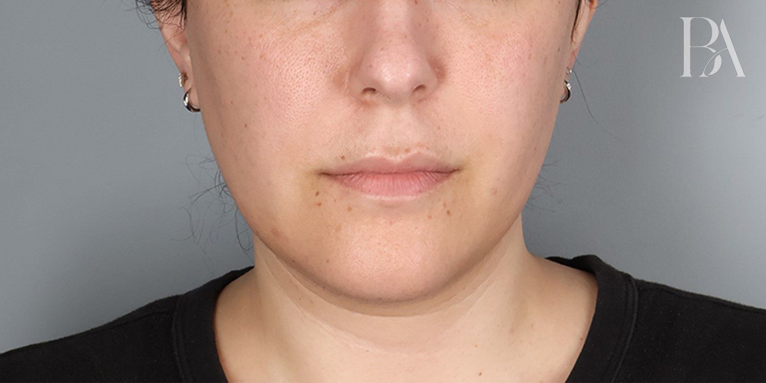 Before — Submental Liposuction