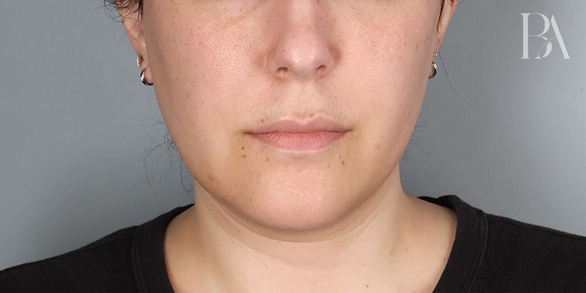 Submental liposuction before — front view, Dr. Beina Azadgoli, Beverly Hills