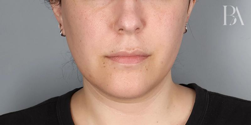 Before — Submental Liposuction