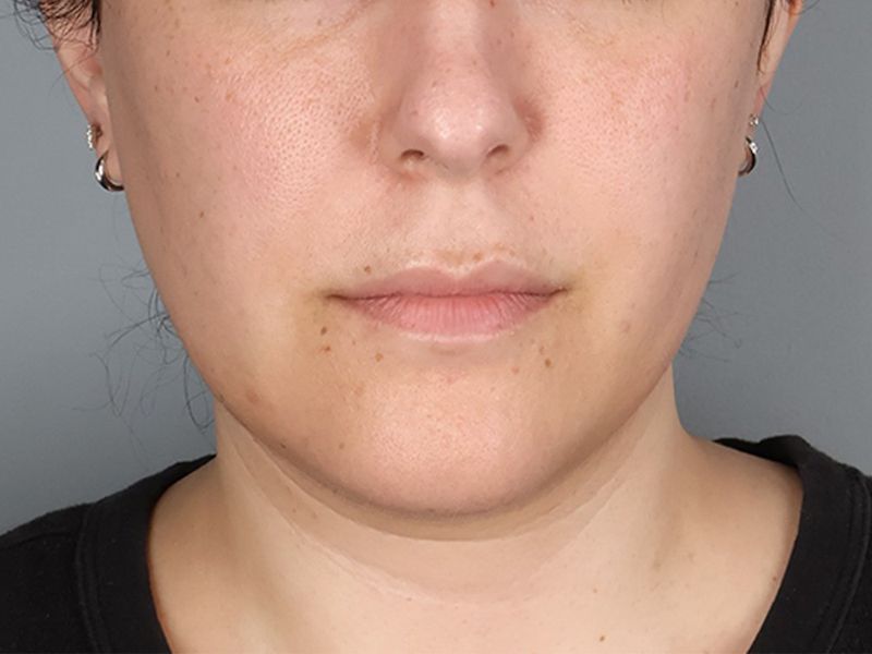 Before — Submental Liposuction