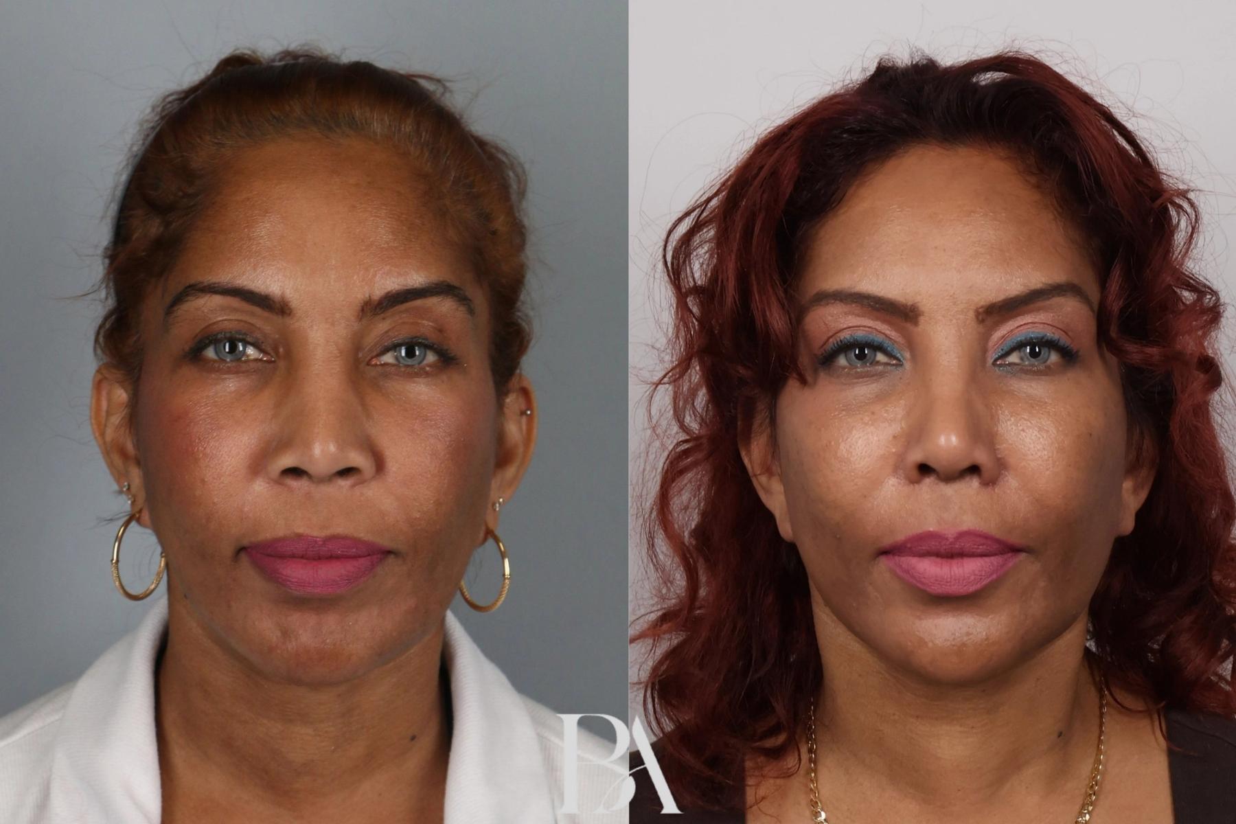 Rhinoplasty before and after — front view, Dr. Beina Azadgoli, Beverly Hills