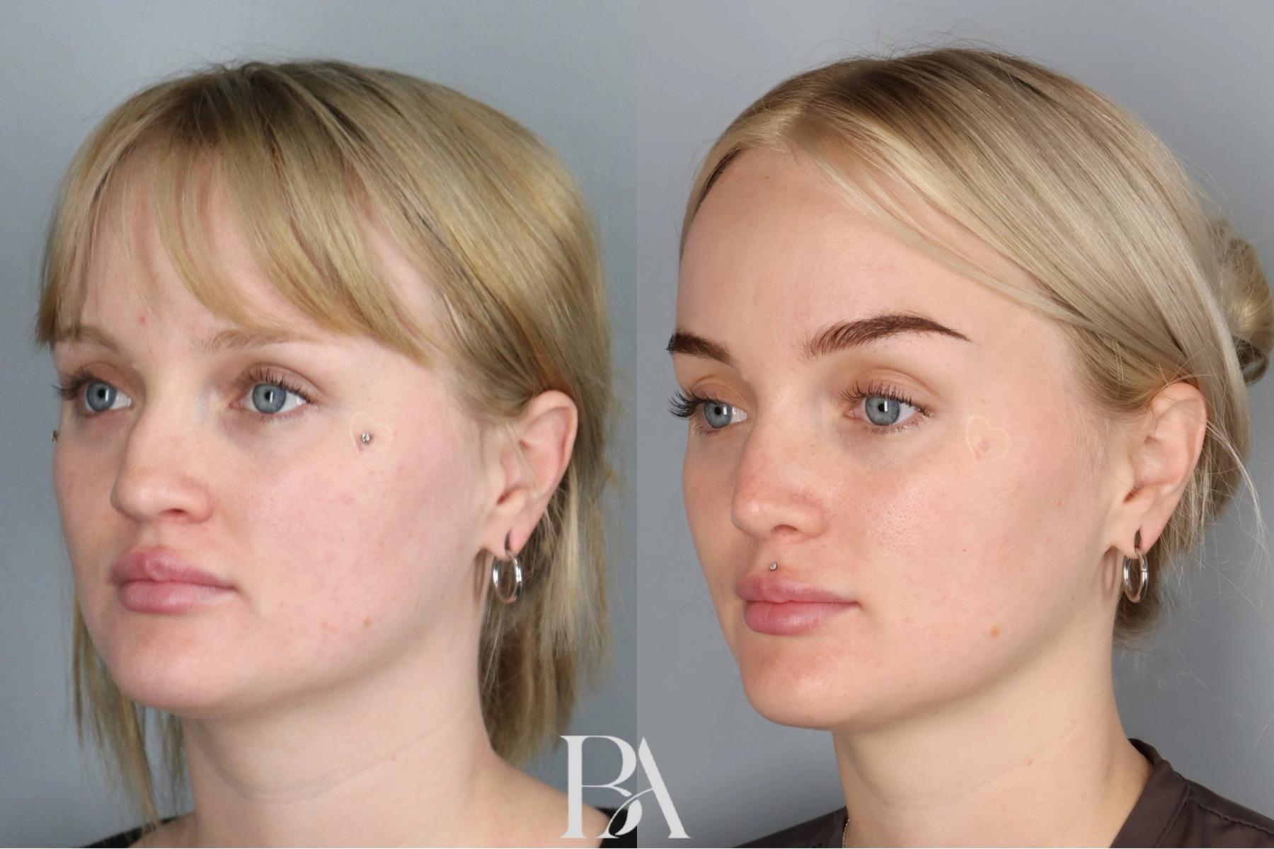 Rhinoplasty before and after — three-quarter view, Dr. Beina Azadgoli, Beverly Hills