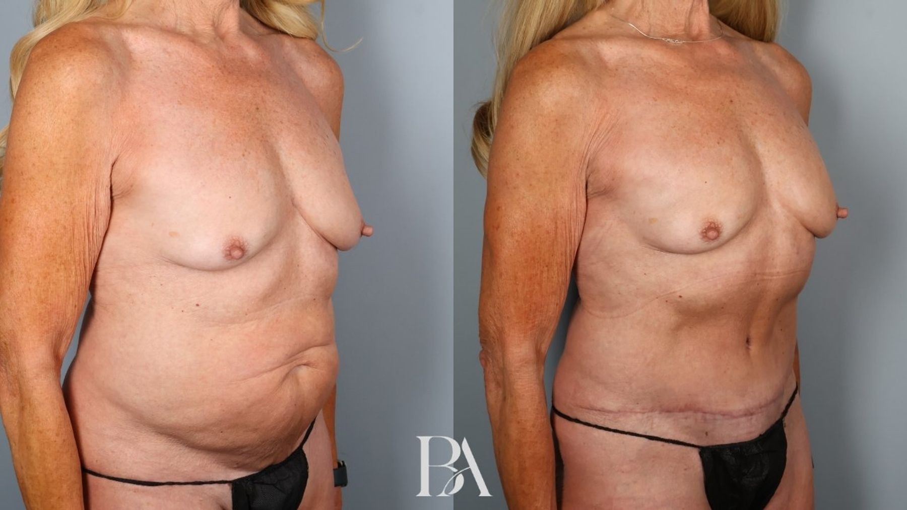 Tummy tuck before and after — oblique view, Dr. Beina Azadgoli, Beverly Hills