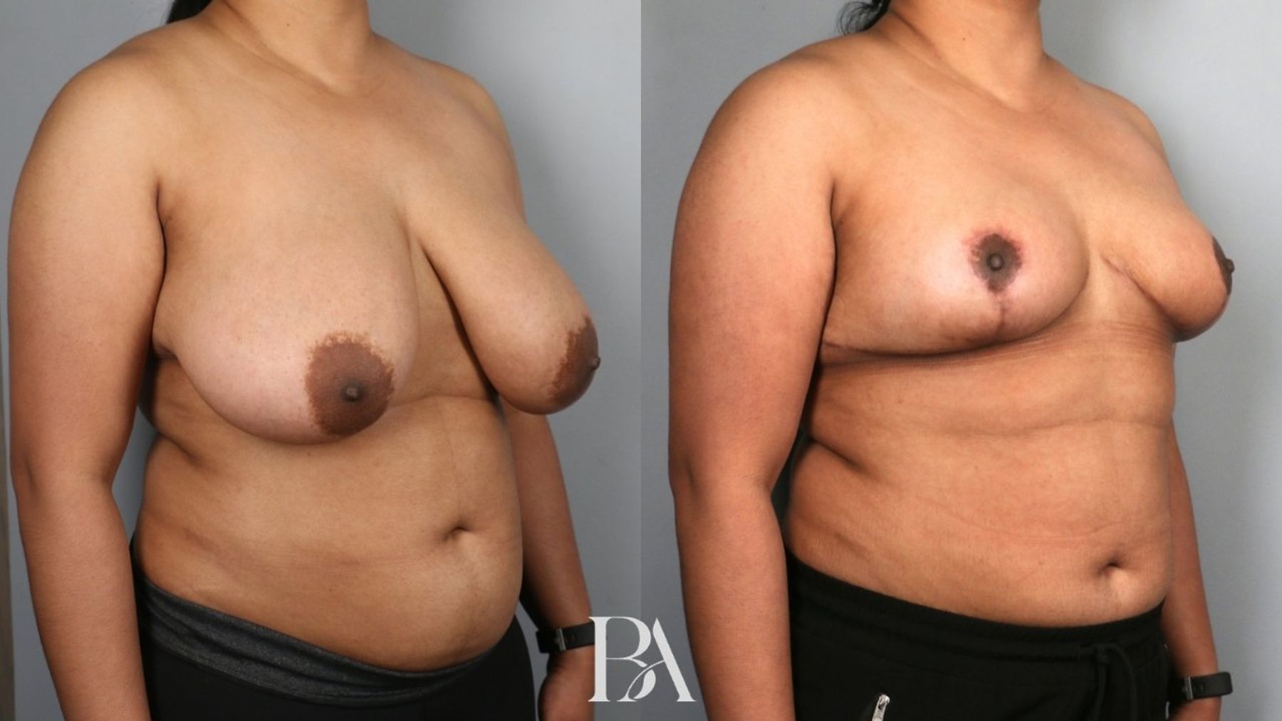 Breast reduction before and after — oblique view, Dr. Beina Azadgoli, Beverly Hills