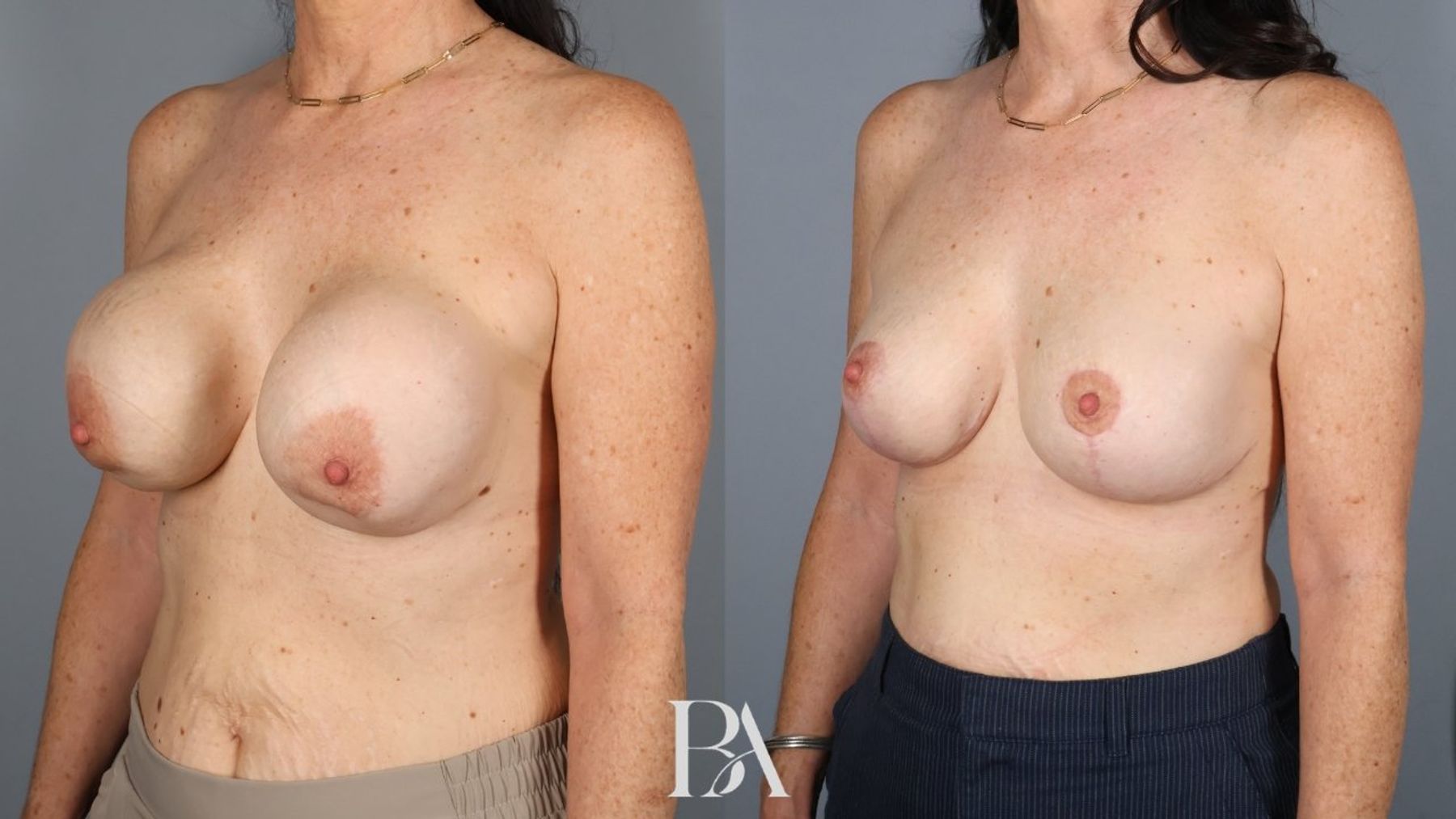 Implant Removal and Replacement before and after — three-quarter view, Dr. Beina Azadgoli, Beverly Hills