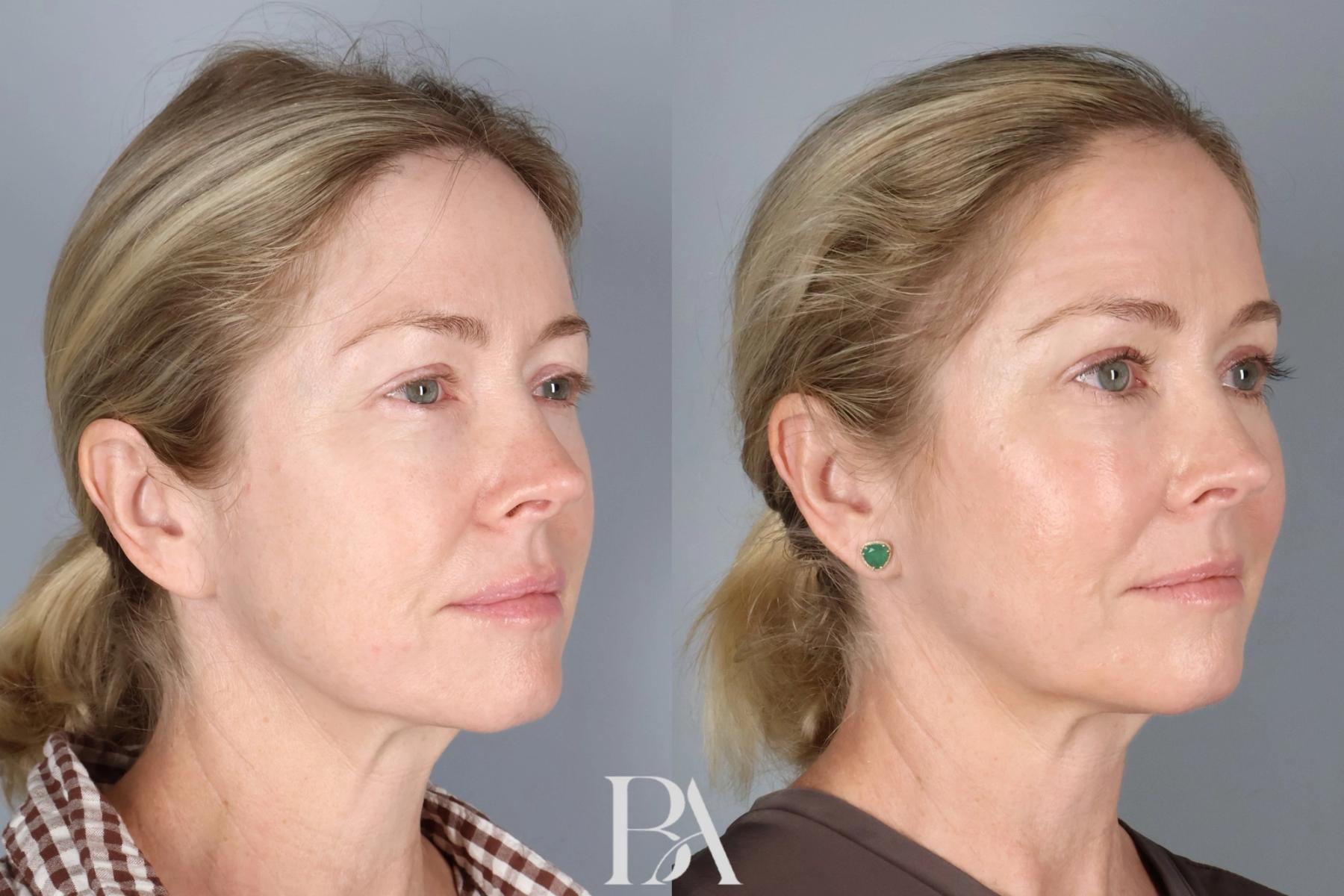 Upper Blepharoplasty before and after — oblique view, Dr. Beina Azadgoli, Beverly Hills