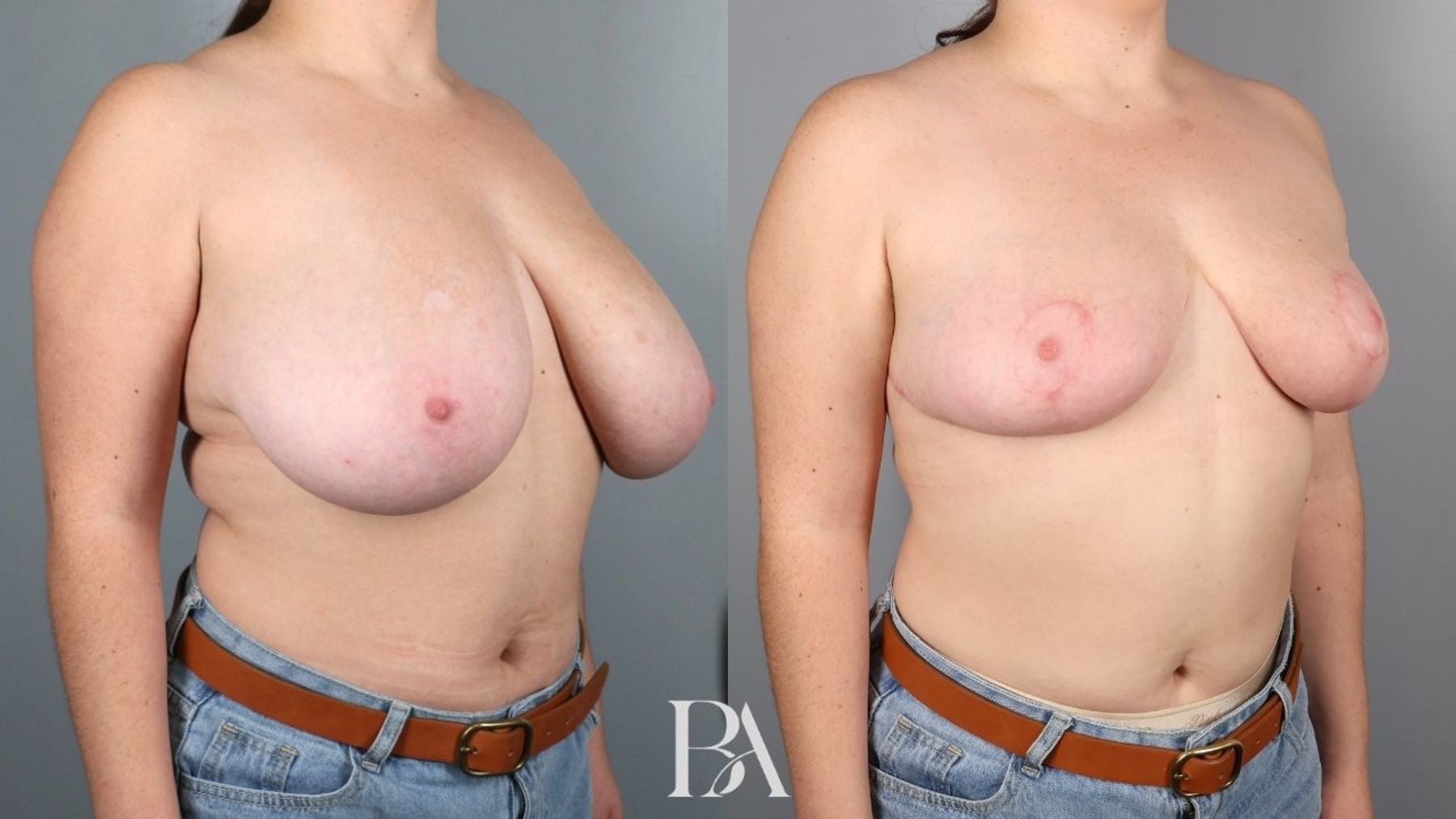Breast reduction before and after — oblique view, Dr. Beina Azadgoli, Beverly Hills