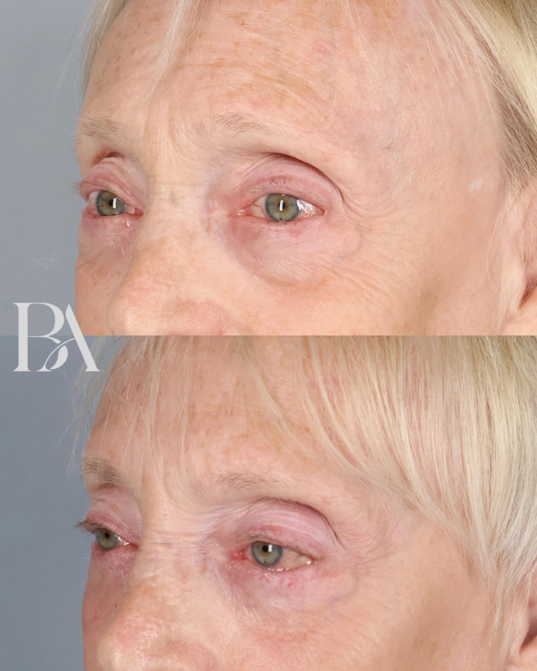 Lower Blepharoplasty before and after — three-quarter view, Dr. Beina Azadgoli, Beverly Hills