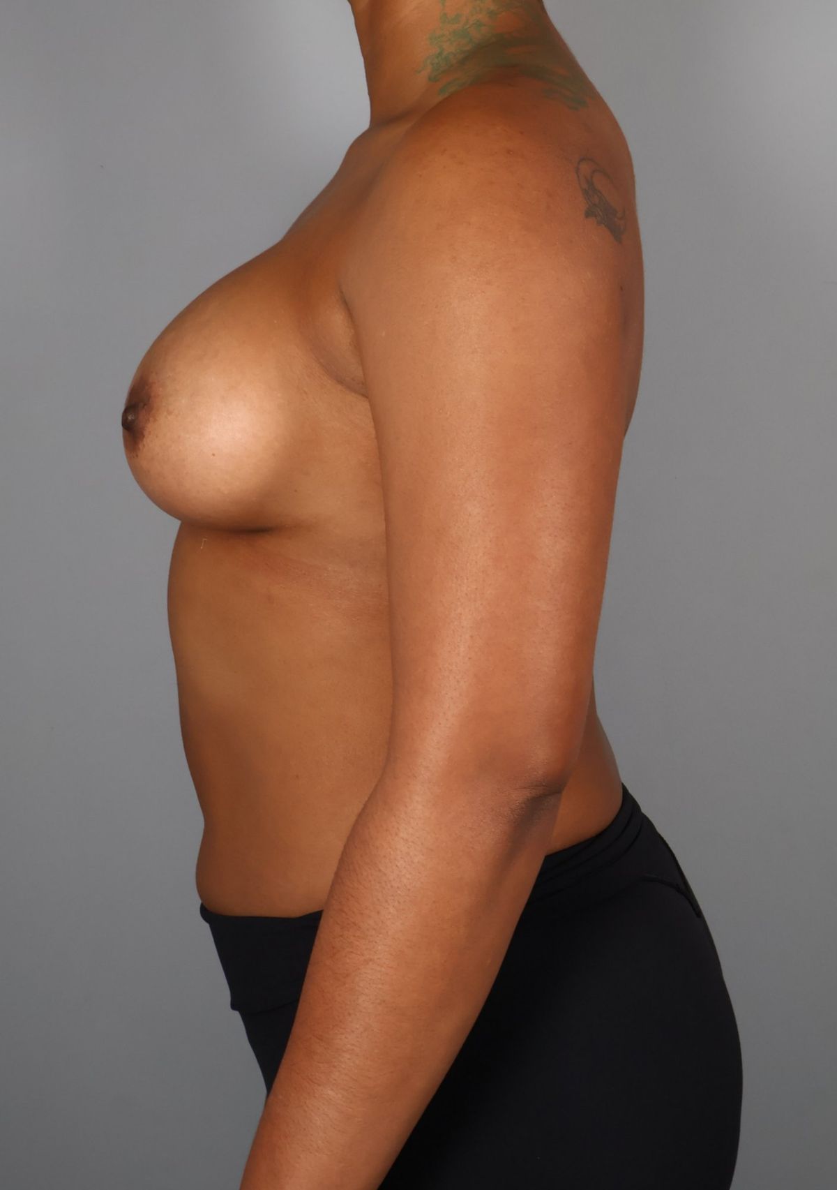 Breast augmentation after — three-quarter view, Dr. Beina Azadgoli, Beverly Hills