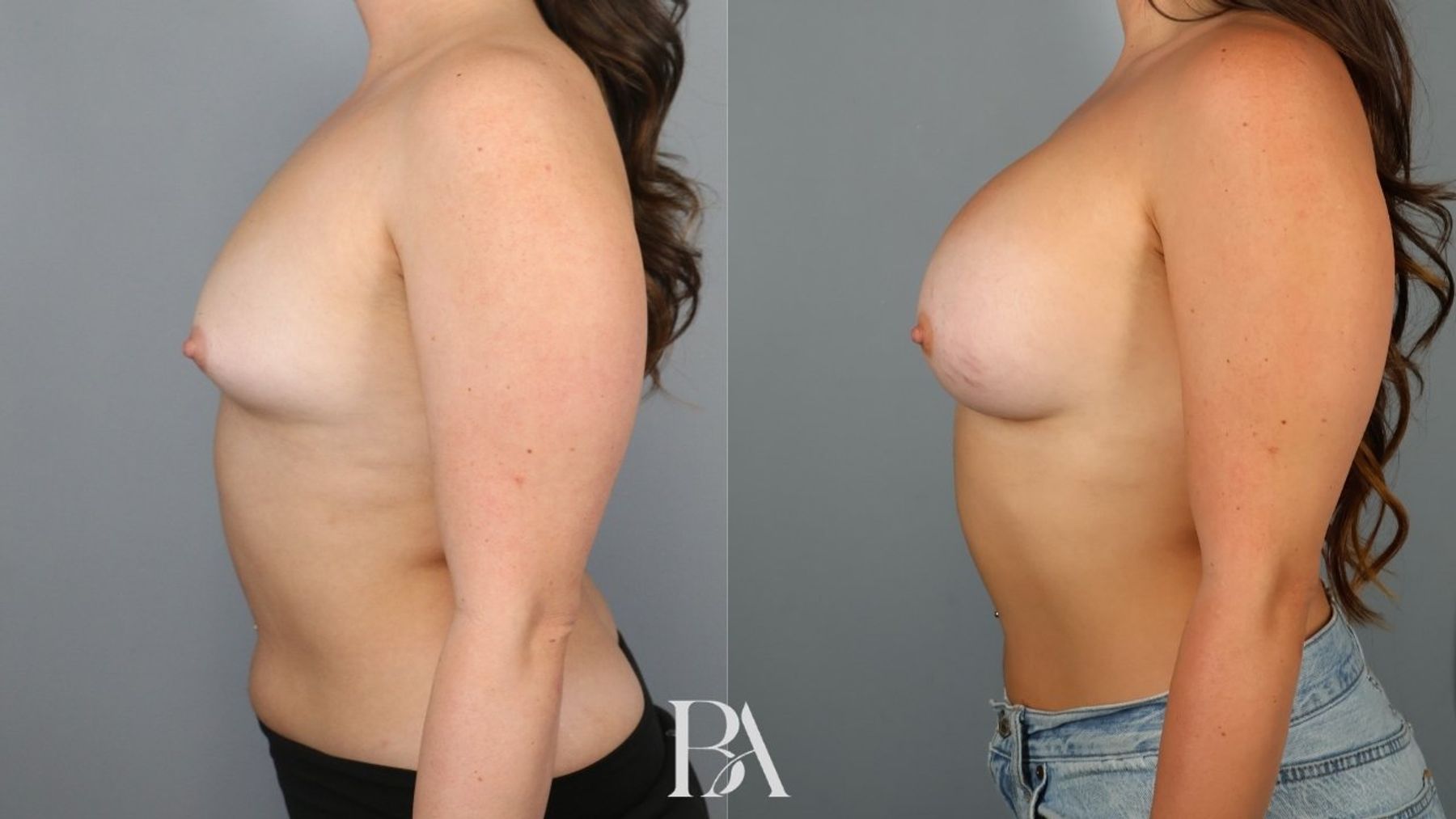 Breast augmentation before and after — side view, Dr. Beina Azadgoli, Beverly Hills