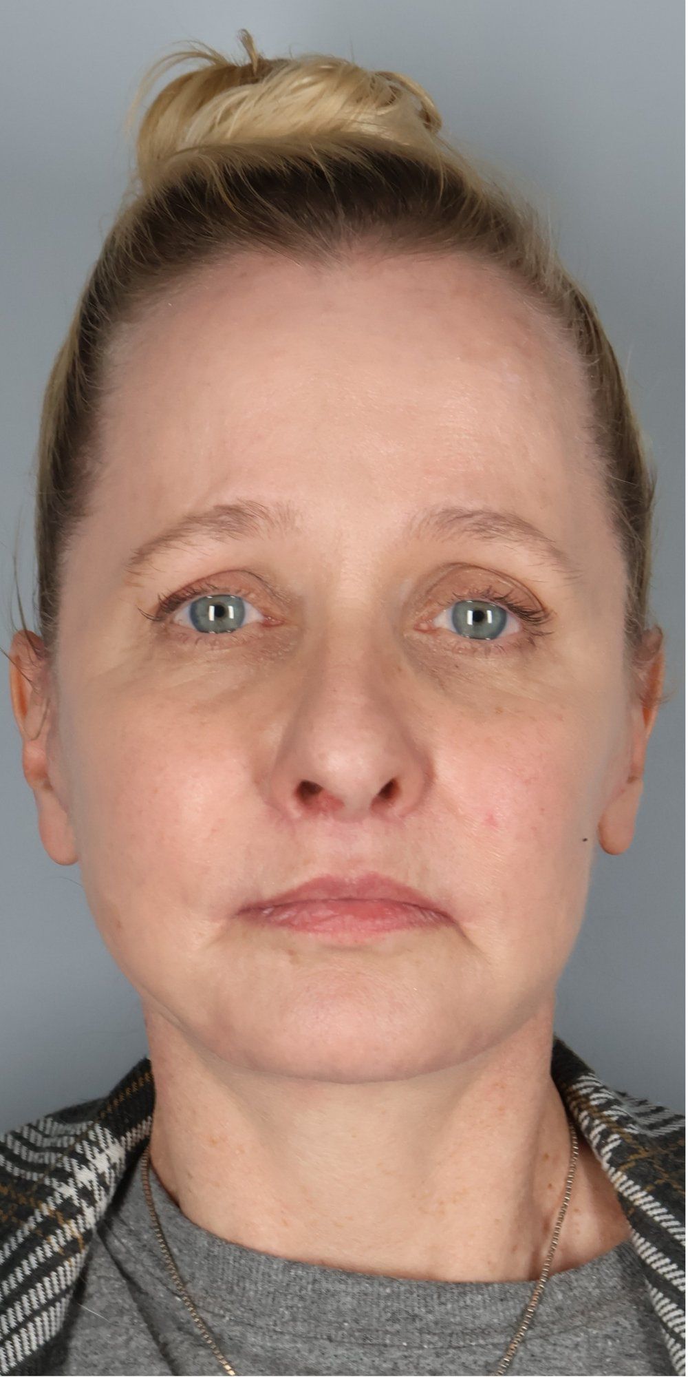 After — Face/Neck Lift