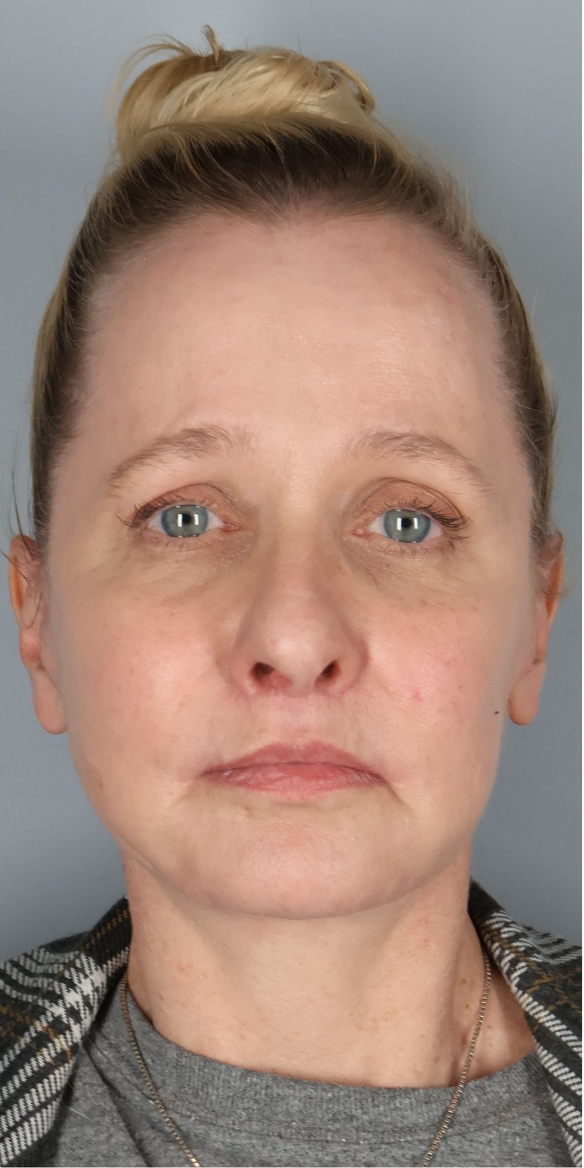 Face/neck lift after — front view, Dr. Beina Azadgoli, Beverly Hills