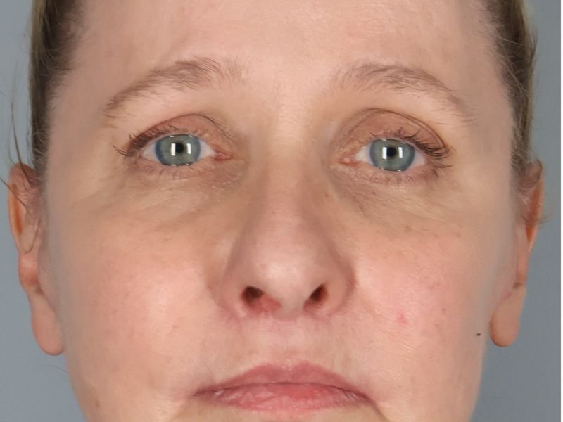 After — Face/Neck Lift
