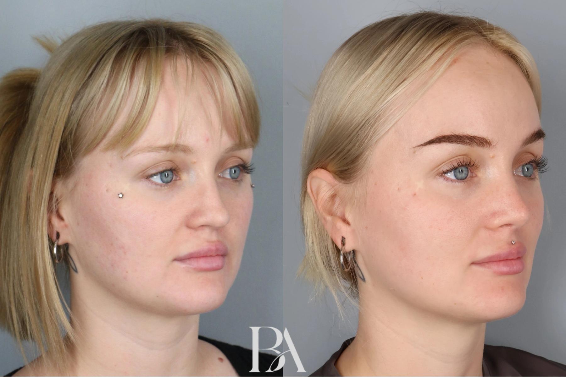 Rhinoplasty before and after — oblique view, Dr. Beina Azadgoli, Beverly Hills
