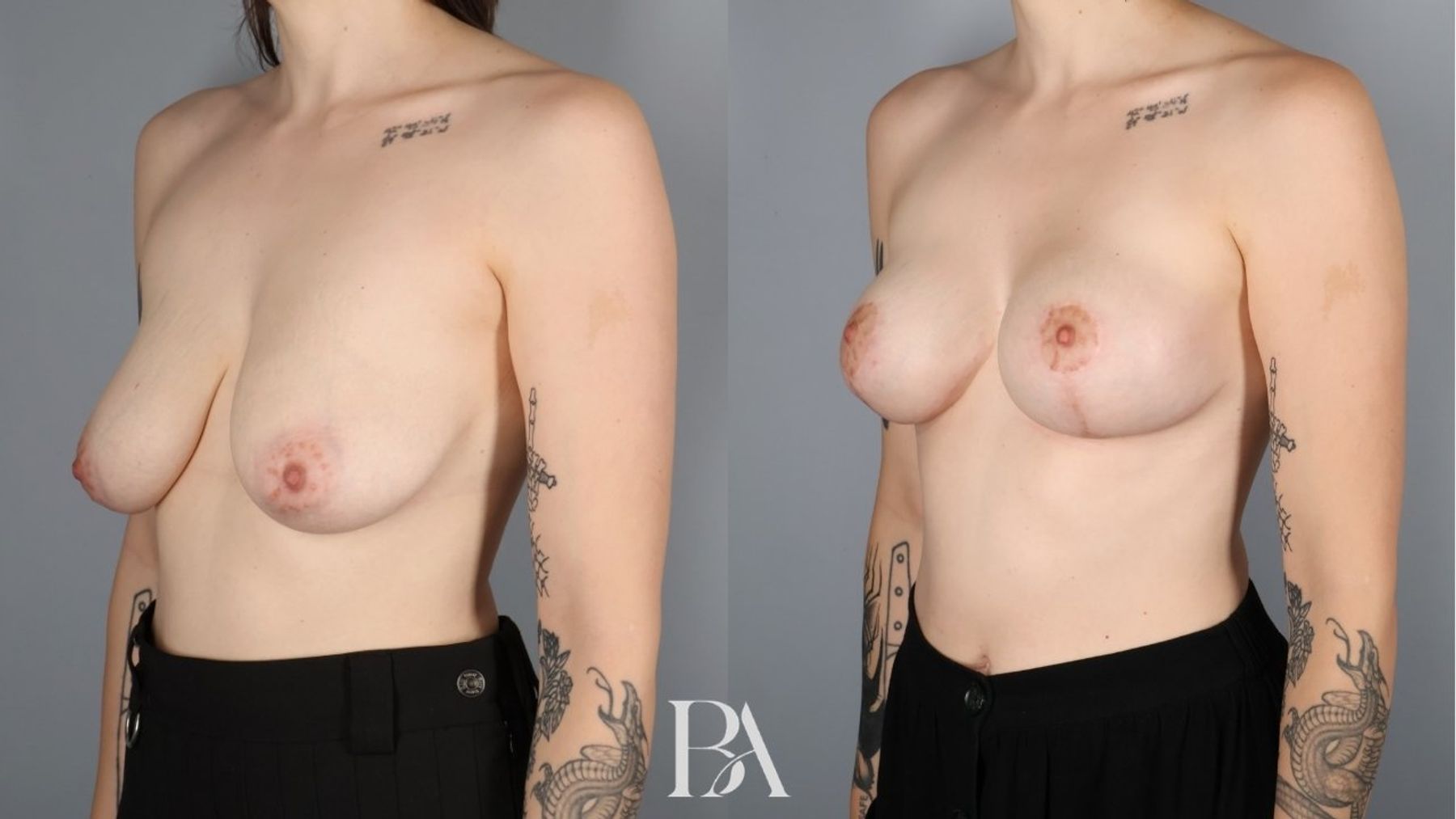 Breast lift before and after — three-quarter view, Dr. Beina Azadgoli, Beverly Hills