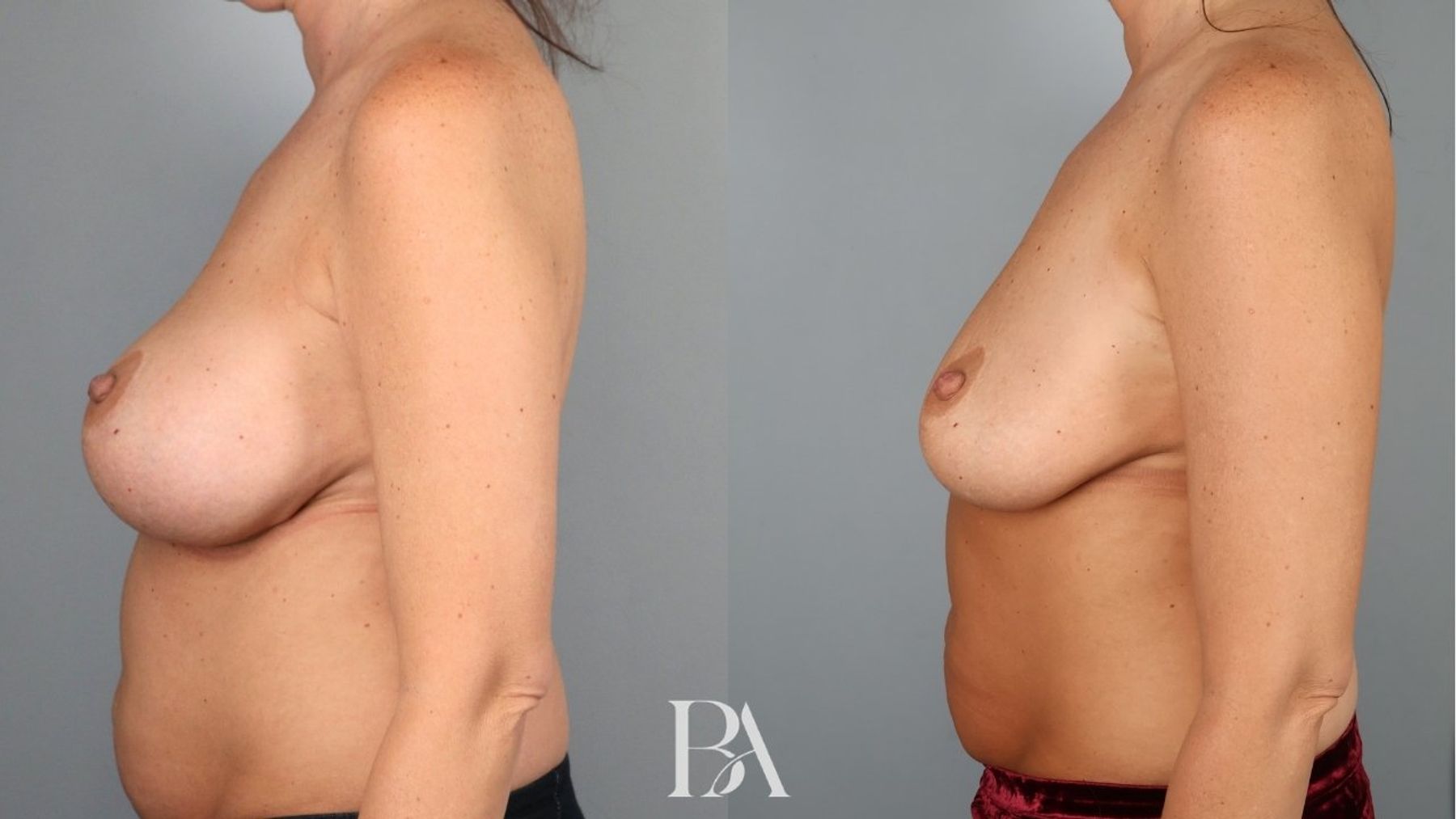 Breast implant removal before and after — side view, Dr. Beina Azadgoli, Beverly Hills