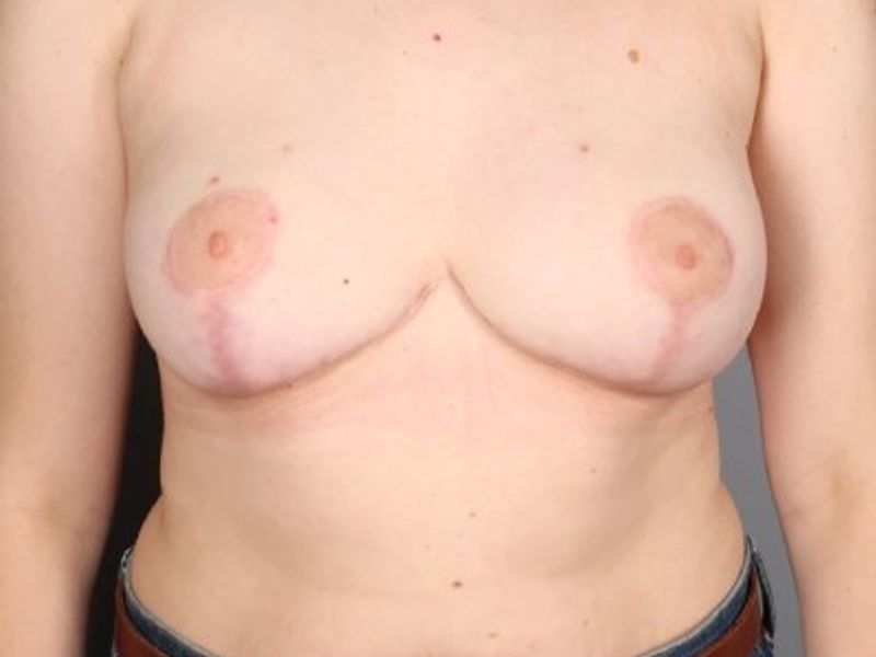 After — Breast Reduction
