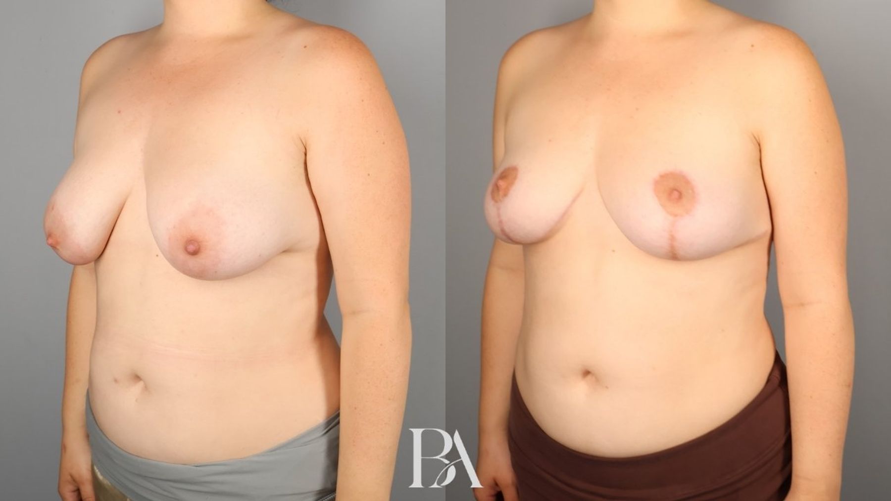 Breast lift before and after — three-quarter view, Dr. Beina Azadgoli, Beverly Hills