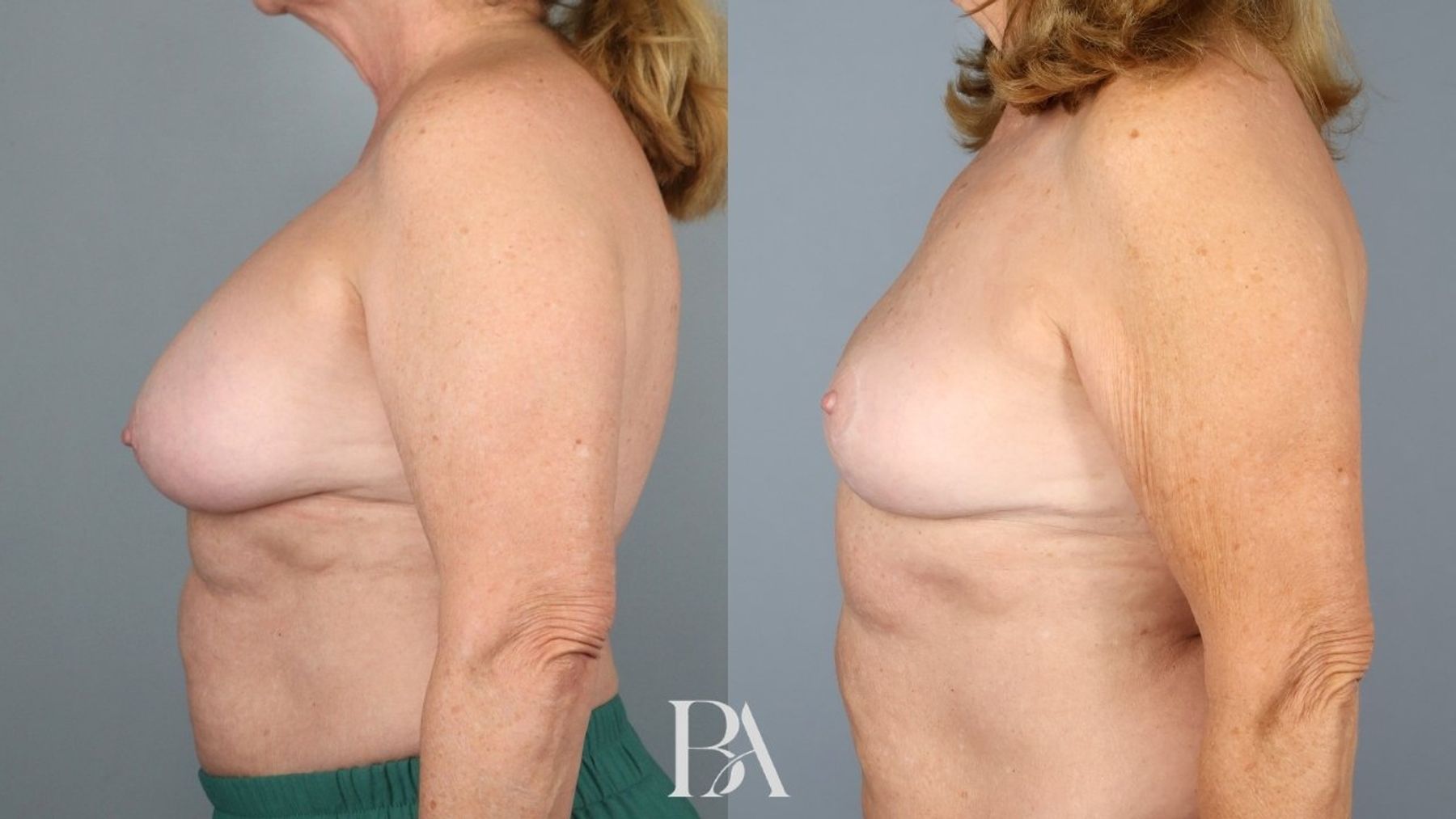 Breast implant removal before and after — side view, Dr. Beina Azadgoli, Beverly Hills