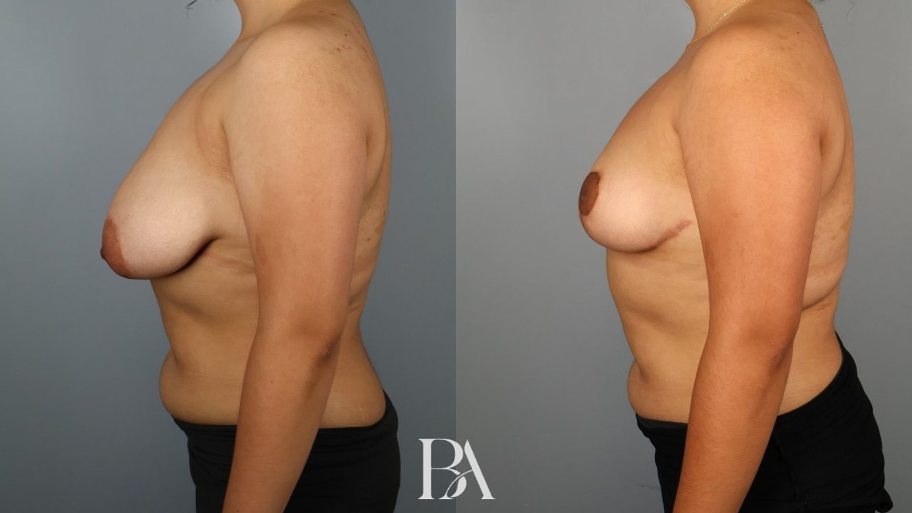 Breast reduction before and after — side view, Dr. Beina Azadgoli, Beverly Hills