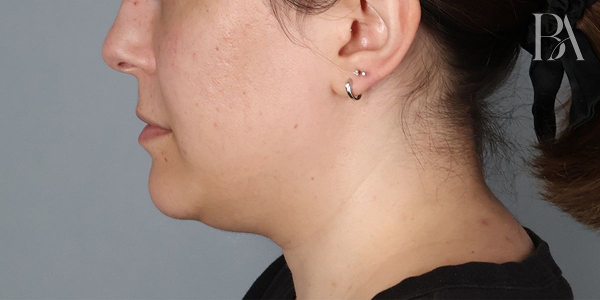 Submental liposuction before — detail view, Dr. Beina Azadgoli, Beverly Hills