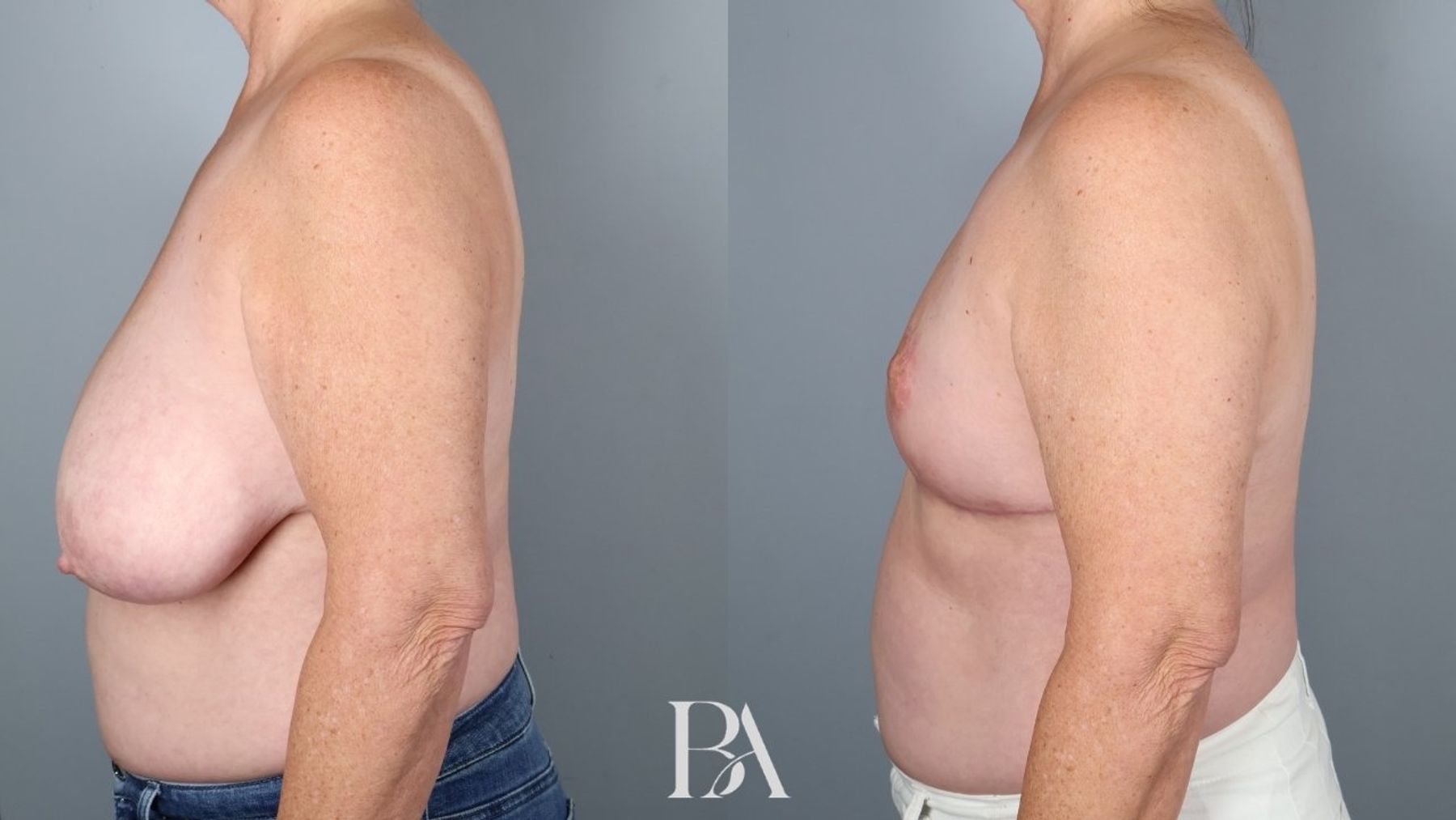 SWIM Flap Reconstruction before and after — side view, Dr. Beina Azadgoli, Beverly Hills