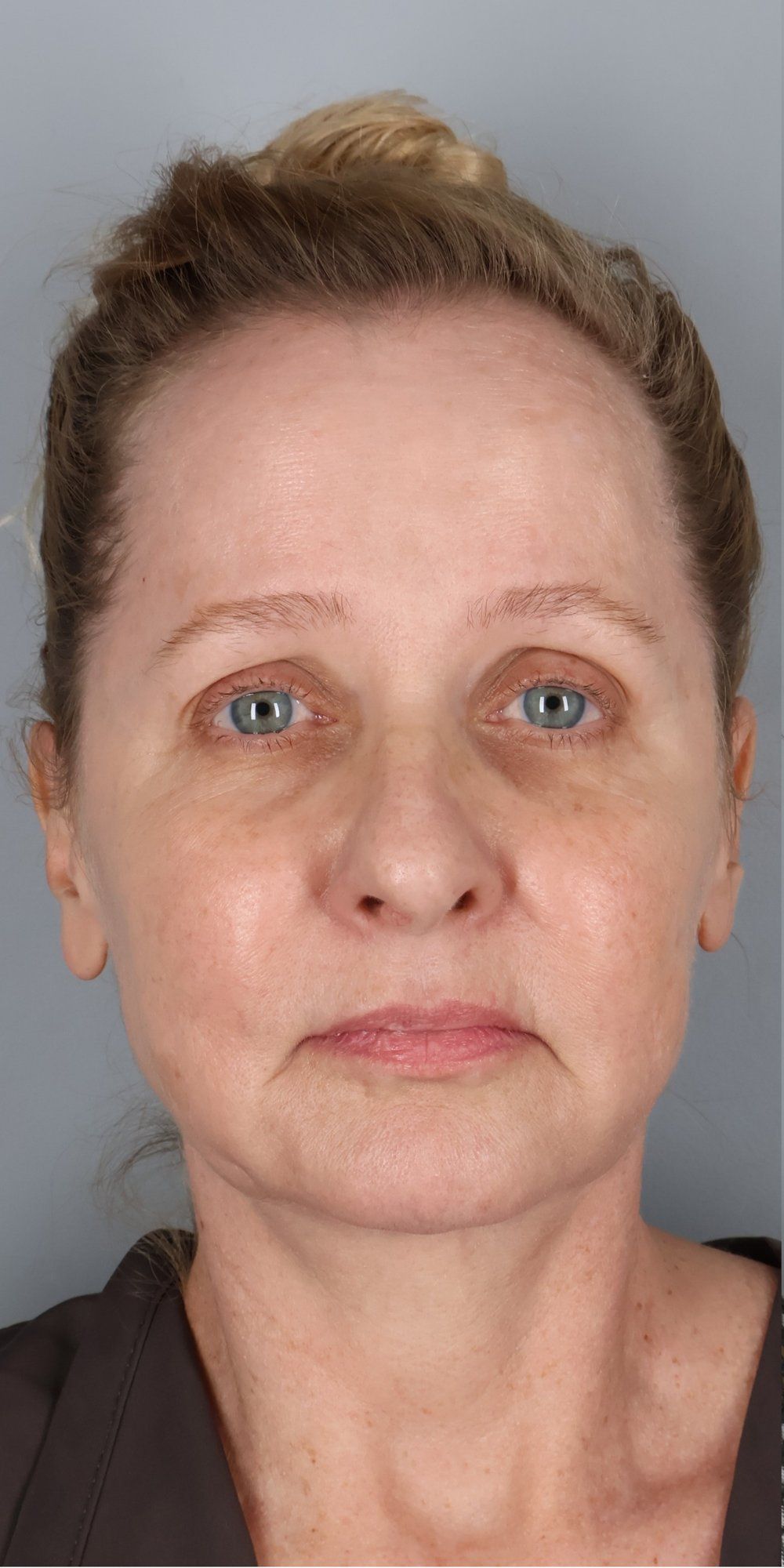 Before — Face/Neck Lift