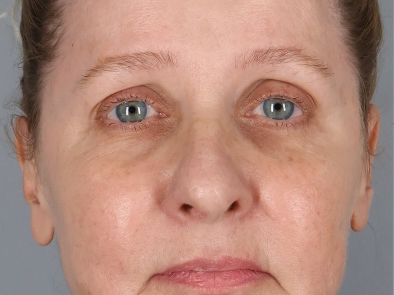 Before — Face/Neck Lift