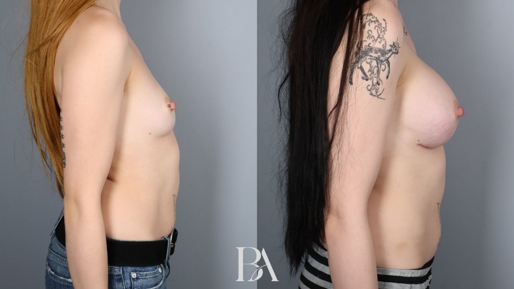 Breast augmentation before and after — side view, Dr. Beina Azadgoli, Beverly Hills
