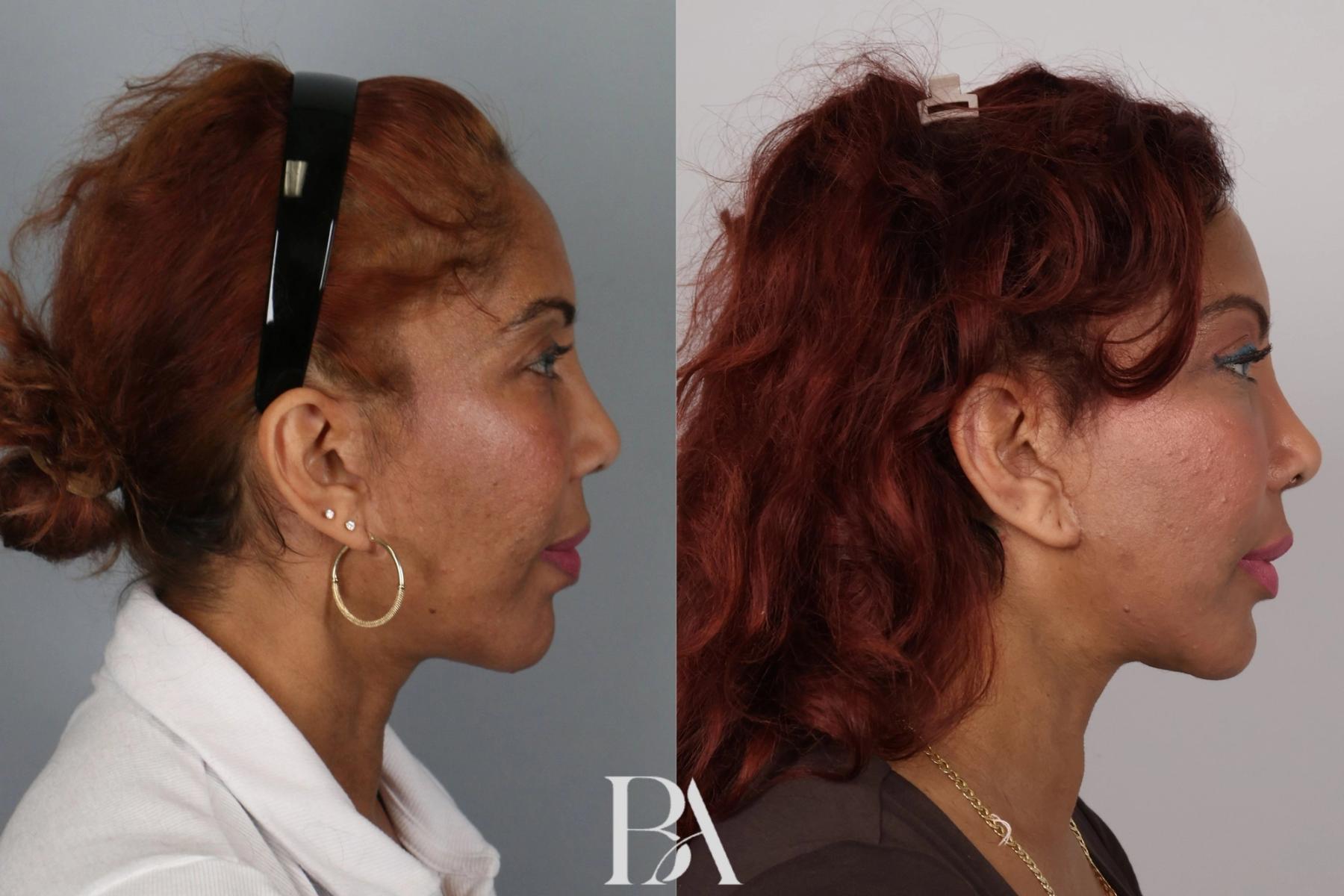 Rhinoplasty before and after — side view, Dr. Beina Azadgoli, Beverly Hills