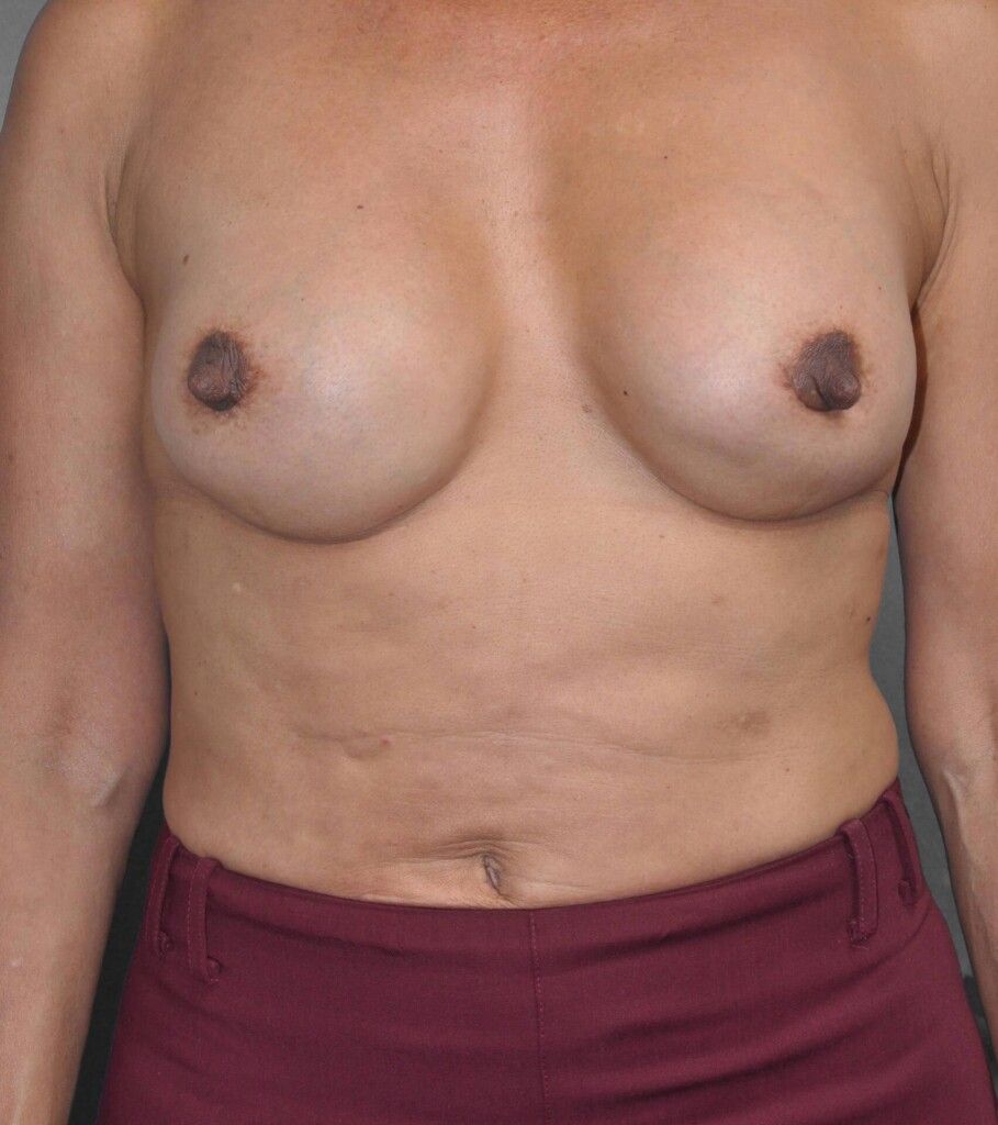 After — Breast Implant Replacement