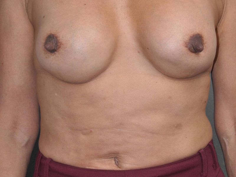 After — Breast Implant Replacement