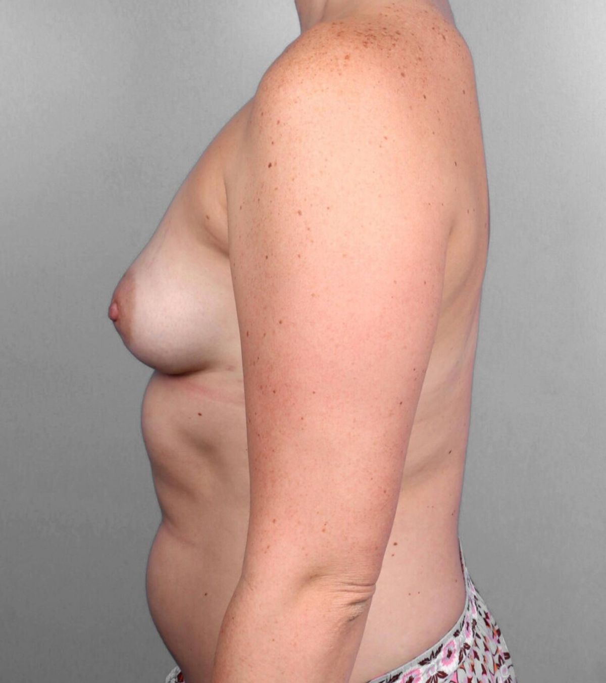 Case 1263 — Oblique after
