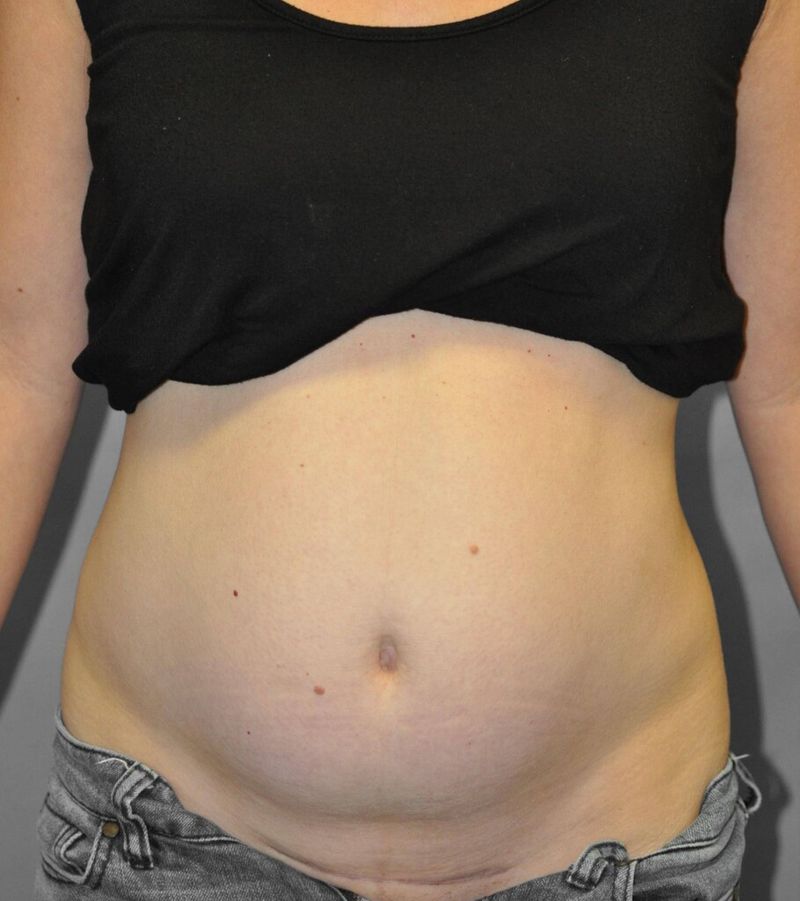 Before — Tummy Tuck