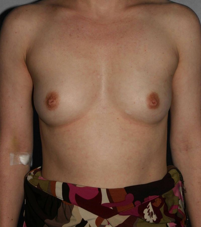 Before — Direct-to-Implant Reconstruction