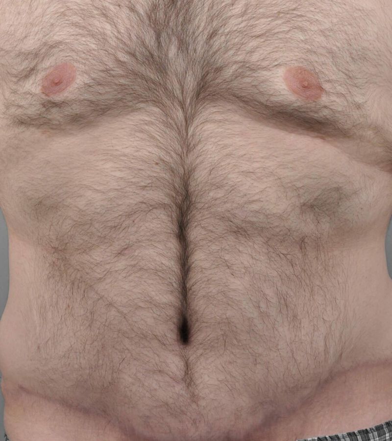 After — Tummy Tuck