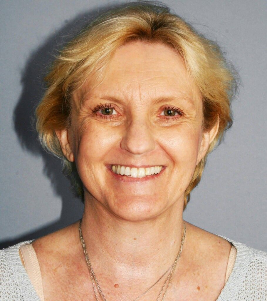 After — Facelift