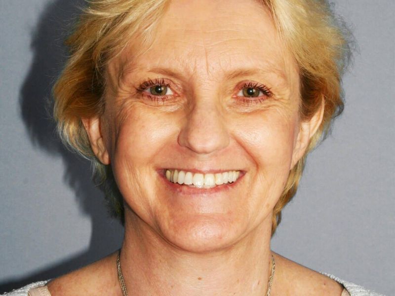 After — Facelift