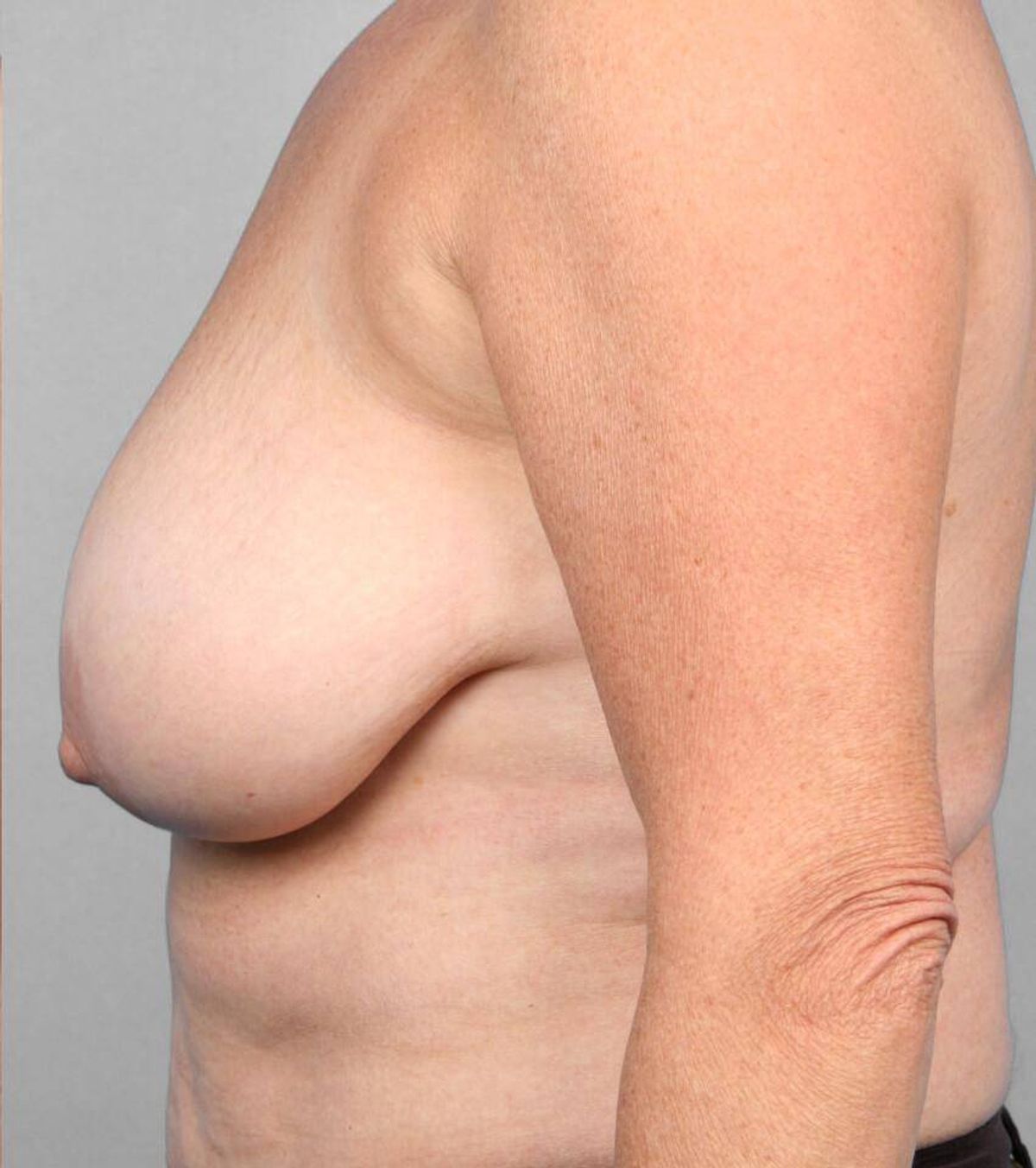 Case 1485 — Oblique before