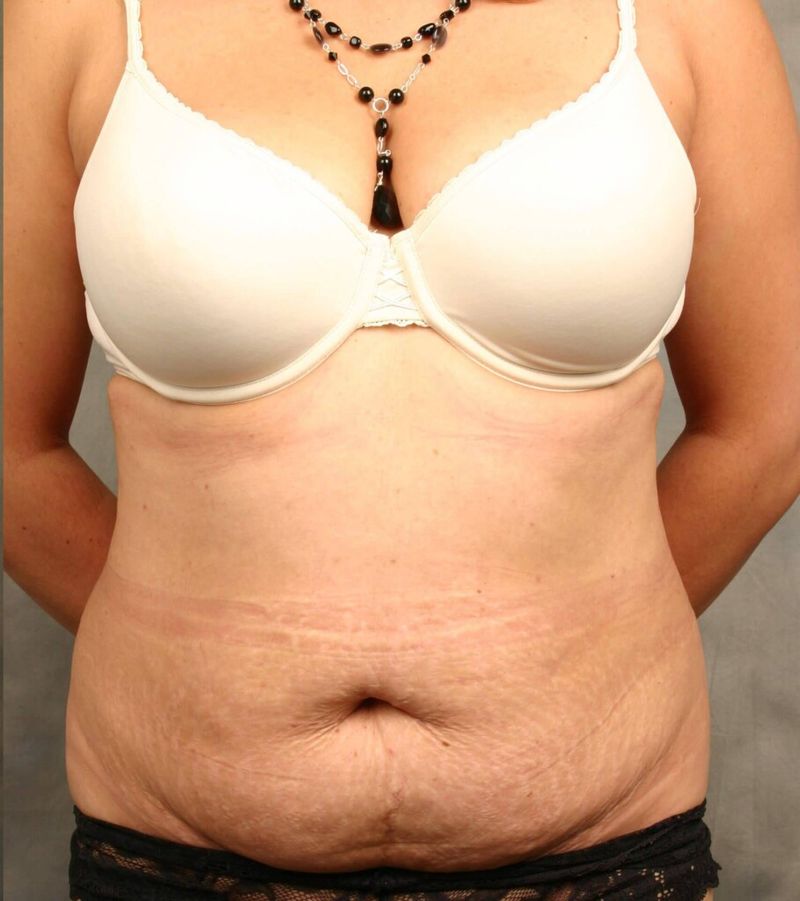 Before — Tummy Tuck