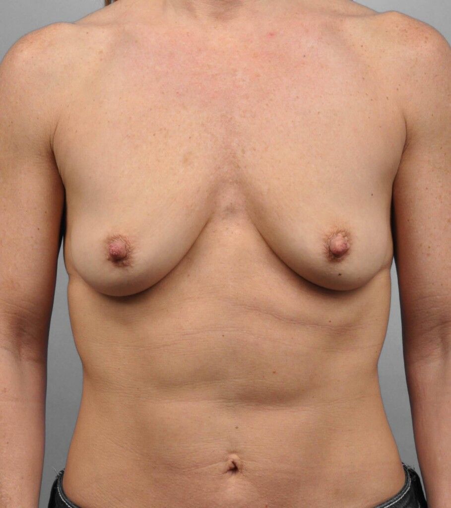 Before — Breast Augmentation
