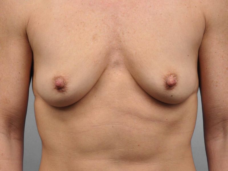 Before — Breast Augmentation