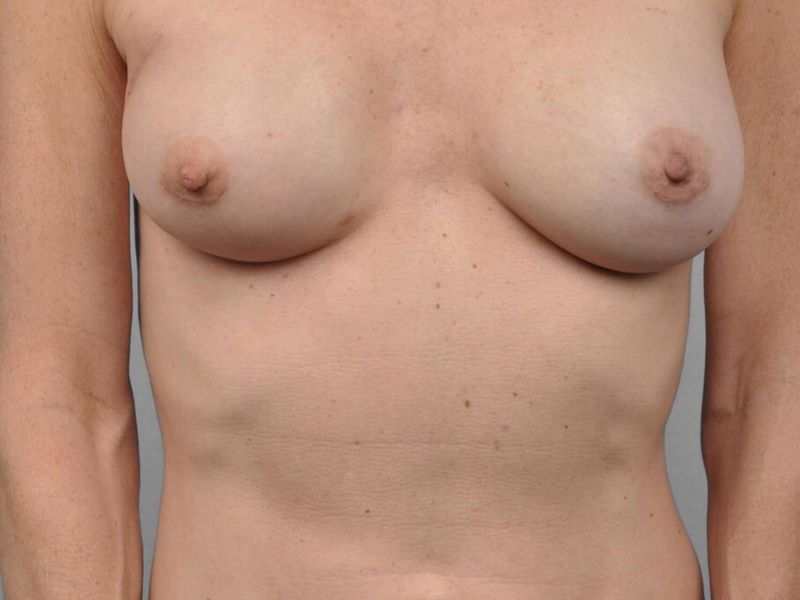 After — Breast Reconstruction Revision