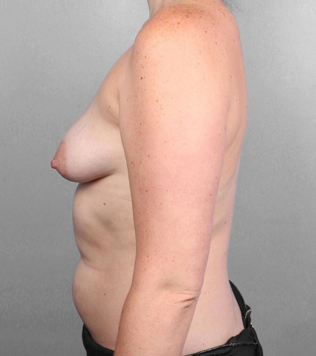 Case 1263 — Oblique before