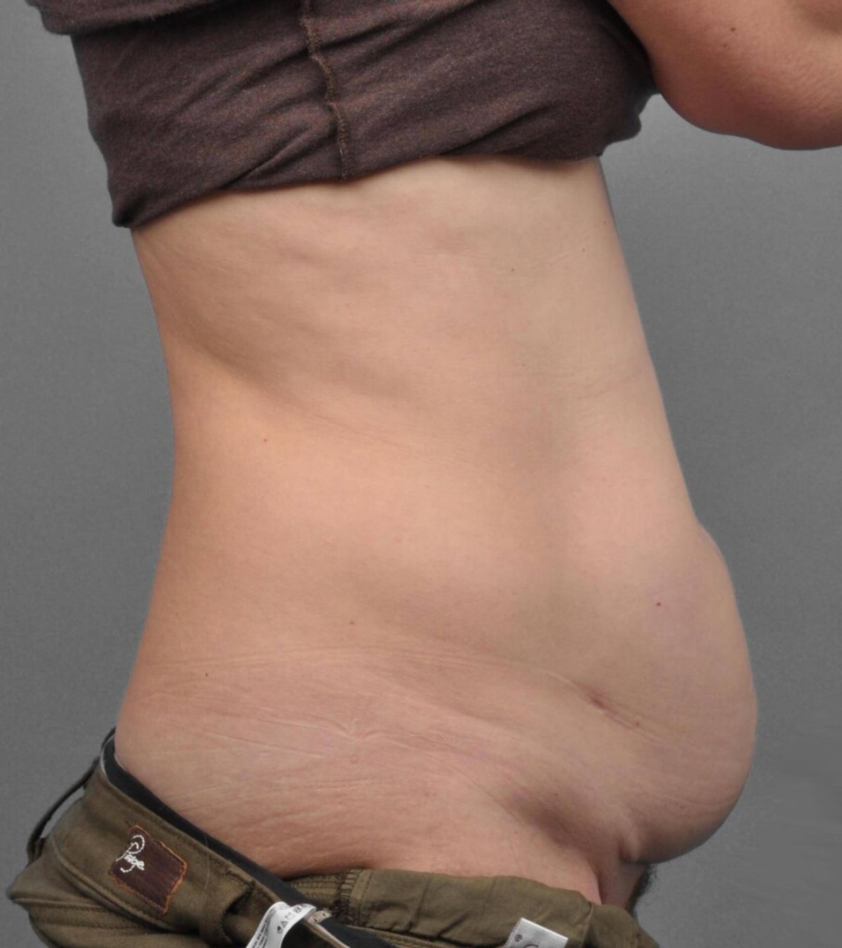 Case 1694 — Oblique before