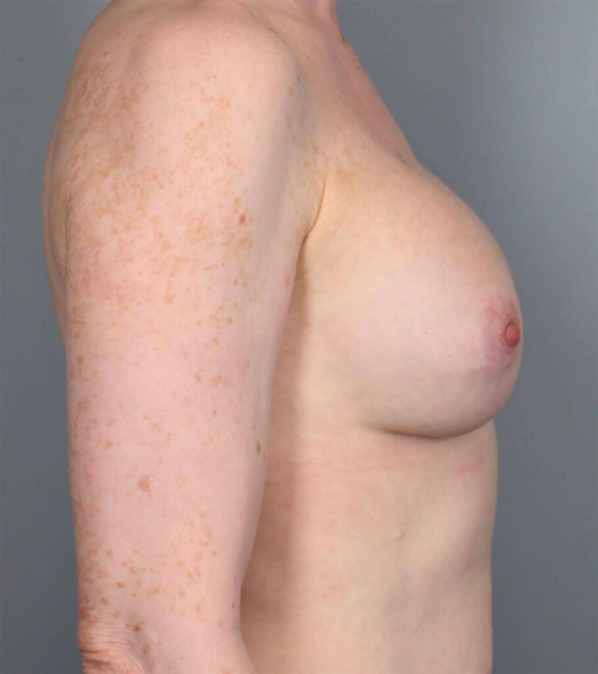 Case 1477 — Oblique after
