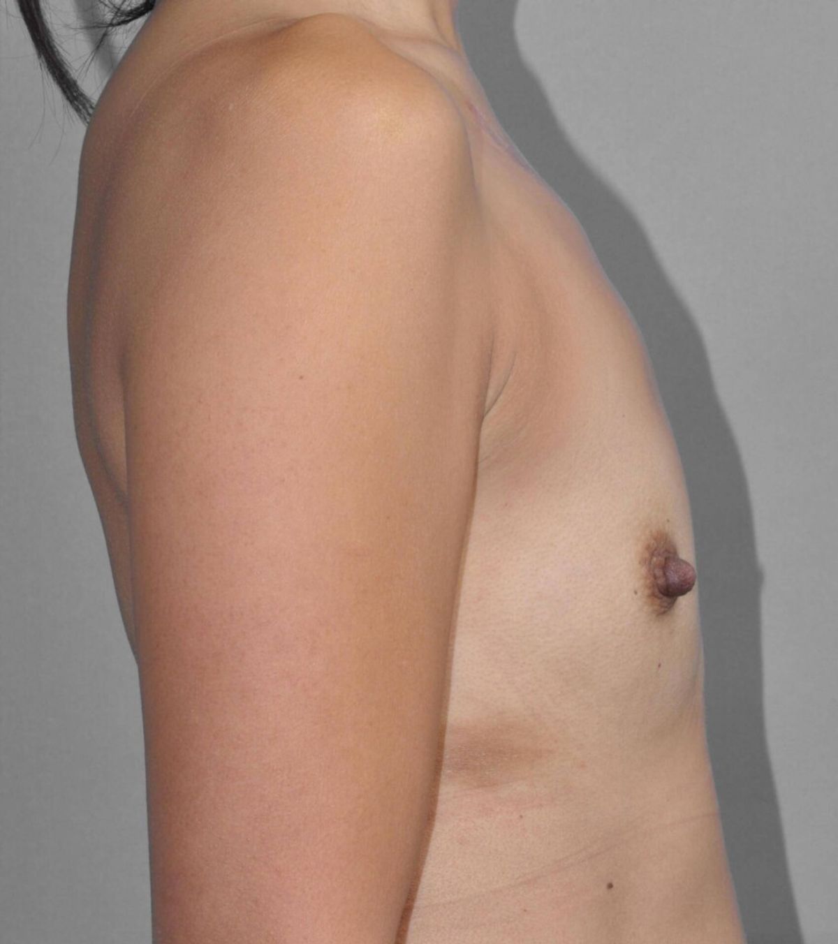 Case 1423 — Oblique before