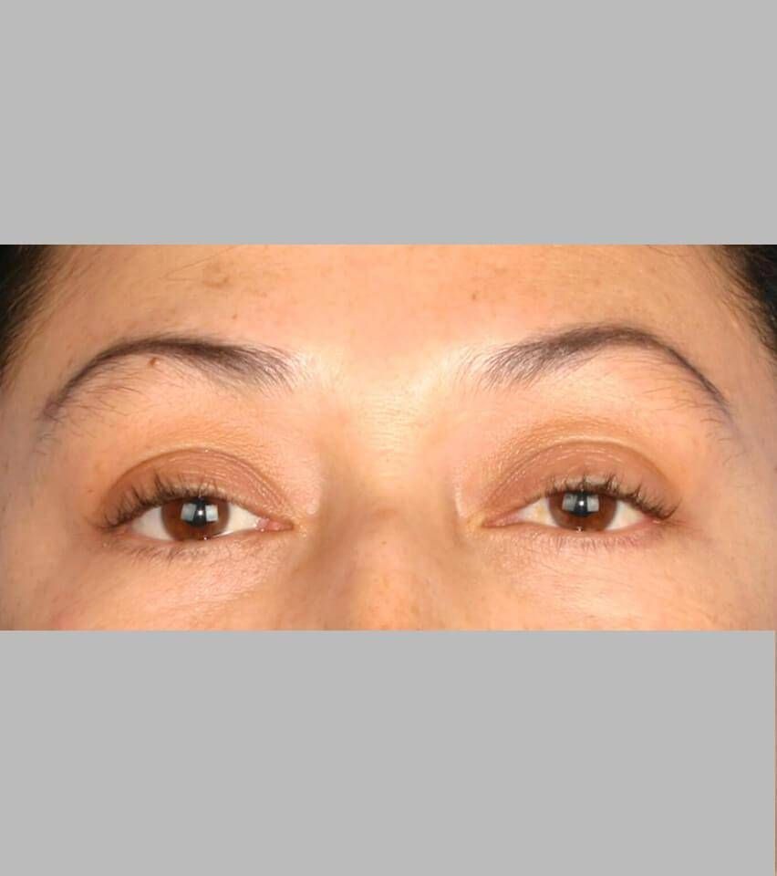 After — Blepharoplasty
